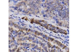 Immunohistochemistry of paraffin-embedded Human thyroid cancer using SNCG Polyclonal Antibody at dilution of 1:200 (40x lens). (SNCG Antikörper)