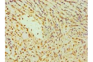 Immunohistochemistry of paraffin-embedded human breast cancer using ABIN7142266 at dilution of 1:100 (DAP3 Antikörper  (AA 159-398))