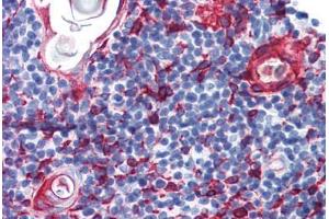 Human Thymus (formalin-fixed, paraffin-embedded) stained with KRT13 antibody ABIN364278 at 10 ug/ml followed by biotinylated anti-mouse IgG secondary antibody ABIN481714, alkaline phosphatase-streptavidin and chromogen. (Cytokeratin 13 Antikörper)