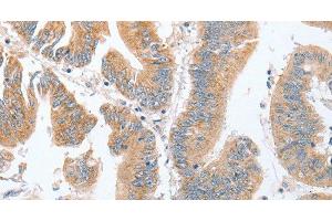 Immunohistochemistry of paraffin-embedded Human colon cancer tissue using PARD6A Polyclonal Antibody at dilution 1:60 (PARD6A Antikörper)