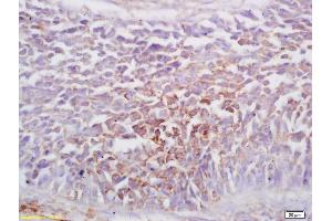 Formalin-fixed and paraffin embedded human lung carcinoma labeled with Rabbit Anti EphA1/Ephrina1/Ephrin A1 Receptor Polyclonal Antibody, Unconjugated (ABIN734108) at 1:200 followed by conjugation to the secondary antibody and DAB staining
