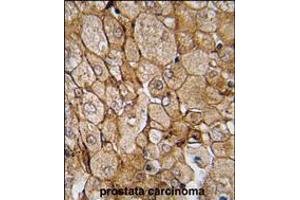 Formalin-fixed and paraffin-embedded human prostata carcinoma tissue reacted with CAMK1G (Center K226) , which was peroxidase-conjugated to the secondary antibody, followed by DAB staining.