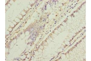 Immunohistochemistry of paraffin-embedded human colon cancer using ABIN7174715 at dilution of 1:100 (C11orf53 Antikörper  (AA 13-236))