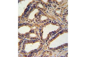 Formalin-fixed and paraffin-embedded human prostate carcinoma with NA Antibody (N-term), which was peroxidase-conjugated to the secondary antibody, followed by DAB staining. (NPPA Antikörper  (N-Term))