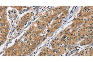 Immunohistochemistry of paraffin-embedded Human gastric cancer using COPB1 Polyclonal Antibody at dilution of 1:50 (COPB1 Antikörper)