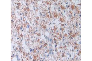 IHC-P analysis of glioma tissue, with DAB staining. (Factor VIII Antikörper  (AA 1887-2044))