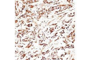 Immunohistochemistry of paraffin-embedded human breast cancer using KLHL9 antibody (ABIN6132083, ABIN6142940, ABIN6142941 and ABIN6214299) at dilution of 1:100 (40x lens). (KLHL9 Antikörper  (AA 1-100))