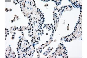 Immunohistochemical staining of paraffin-embedded Adenocarcinoma of breast tissue using anti-MAP2K4 mouse monoclonal antibody. (MAP2K4 Antikörper)
