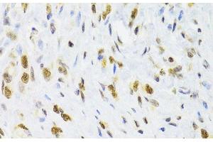 Immunohistochemistry of paraffin-embedded Human gastric cancer using DOK1 Polyclonal Antibody at dilution of 1:100 (40x lens). (DOK1 Antikörper)