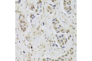 Immunohistochemistry of paraffin-embedded human breast cancer using UBE3C Antibody (ABIN5973842) at dilution of 1/100 (40x lens). (UBE3C Antikörper)