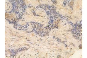 ABIN6261139 and ABIN6266523 at 1/100 staining human breast carcinoma by IHC-P. (Cyclin A1 Antikörper  (C-Term))