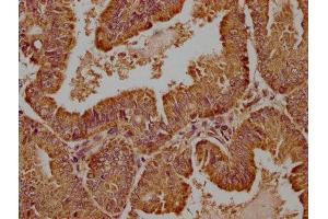 IHC image of ABIN7175790 diluted at 1:100 and staining in paraffin-embedded human endometrial cancer performed on a Leica BondTM system. (WDR73 Antikörper  (AA 163-366))