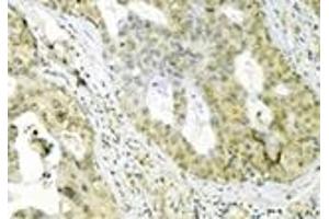 Immunohistochemistry analysis of human breast cancer tissue immunohistochemically stained using Grp75 mAb (30A5). (HSPA9 Antikörper)