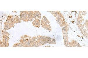 Immunohistochemistry of paraffin-embedded Human liver cancer tissue using PSMA4 Polyclonal Antibody at dilution of 1:50(x200) (PSMA4 Antikörper)