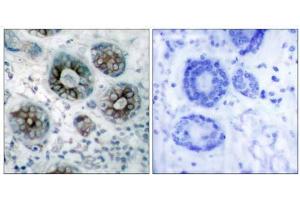 Immunohistochemical analysis of paraffin-embedded human breast carcinoma tissue, using GAP43 (Ab-41) antibody (E021273). (GAP43 Antikörper)