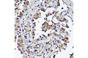 Immunohistochemistry of paraffin-embedded human lung cancer using PHD3 Rabbit pAb (ABIN6130355, ABIN6139990, ABIN6139991 and ABIN6224021) at dilution of 1:150 (40x lens). (EGLN3 Antikörper  (AA 1-120))