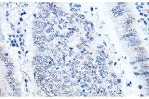 Immunohistochemistry of paraffin-embedded Human colon carcinoma using ADAR Polyclonal Antibody at dilution of 1:100 (40x lens). (ADAR Antikörper)