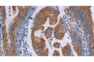 Immunohistochemistry of paraffin-embedded Human gasrtic cancer tissue using ACP6 Polyclonal Antibody at dilution 1:50 (ACP6 Antikörper)