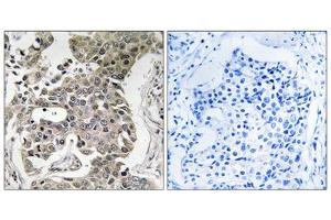 Immunohistochemistry analysis of paraffin-embedded human breast carcinoma tissue using PPP2R1B antibody. (PPP2R1B Antikörper  (C-Term))