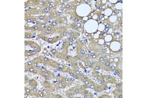 Immunohistochemistry of paraffin-embedded human liver injury using HYAL1 antibody (ABIN5975045) at dilution of 1/100 (40x lens). (HYAL1 Antikörper)