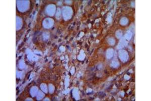Immunohistochemical analysis of paraffin-embedded colon cancer tissues using CHD3 mouse mAb with DAB staining. (CHD3 Antikörper)
