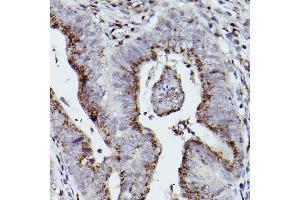 Immunohistochemistry of paraffin-embedded human colon carcinoma using GOLGB1 Rabbit pAb (ABIN7267498) at dilution of 1:100 (40x lens). (Golgin B1 (GOLGB1) Antikörper)