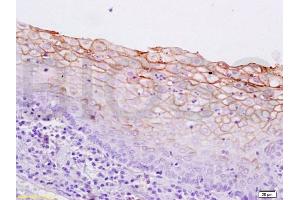 Formalin-fixed and paraffin embedded human breast carcinoma labeled with Anti-pan Cytokeratin Polyclonal Antibody, Unconjugated  at 1:200 followed by conjugation to the secondary antibody and DAB staining. (pan Keratin Antikörper  (AA 331-430))