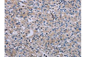 The image on the left is immunohistochemistry of paraffin-embedded Human prostate cancer tissue using ABIN7191769(PAGE4 Antibody) at dilution 1/40, on the right is treated with synthetic peptide. (PAGE4 Antikörper)