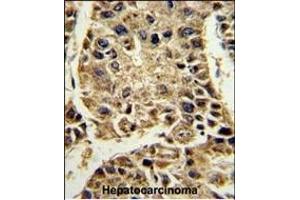 Formalin-fixed and paraffin-embedded human hepatocarcinoma reacted with SERPINA4 Antibody (C-term), which was peroxidase-conjugated to the secondary antibody, followed by DAB staining. (SERPINA4 Antikörper  (C-Term))