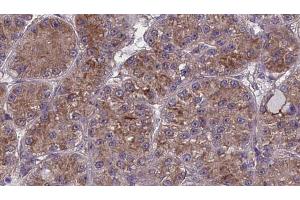 ABIN6273986 at 1/100 staining Human liver cancer tissue by IHC-P. (OR2W1 Antikörper  (C-Term))