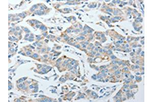 The image on the left is immunohistochemistry of paraffin-embedded Human lung cancer tissue using ABIN7128282(AGA Antibody) at dilution 1/20, on the right is treated with fusion protein. (AGA Antikörper)