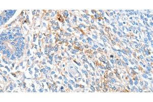 Immunohistochemistry of paraffin-embedded Human ovarian cancer using ALDH1A2 Polyclonal Antibody at dilution of 1:60