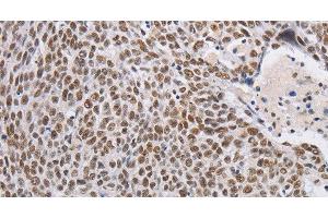 Immunohistochemistry of paraffin-embedded Human lung cancer using THOC7 Polyclonal Antibody at dilution of 1:30 (THOC7 Antikörper)