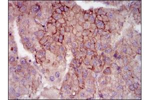 Immunohistochemical analysis of paraffin-embedded liver cancer tissues using MELK mouse mAb with DAB staining. (MELK Antikörper  (AA 637-651))