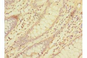Immunohistochemistry of paraffin-embedded human colon cancer using ABIN7158359 at dilution of 1:100 (LMO3 Antikörper  (AA 1-145))