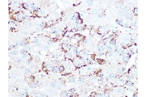 Immunohistochemistry of paraffin-embedded human liver cancer using Cathepsin L/V/K/H Rabbit mAb (ABIN7266150) at dilution of 1:100 (40x lens). (Cathepsin L Antikörper)