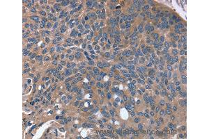 Immunohistochemistry of Human esophagus cancer using RGS4 Polyclonal Antibody at dilution of 1:30 (RGS4 Antikörper)