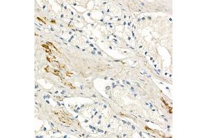 Immunohistochemistry of paraffin-embedded human prostate cancer using MMP7 Rabbit mAb (ABIN7268425) at dilution of 1:150 (40x lens).