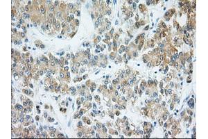 Immunohistochemical staining of paraffin-embedded Adenocarcinoma of Human ovary tissue using anti-H6PD mouse monoclonal antibody. (Glucose-6-Phosphate Dehydrogenase Antikörper)