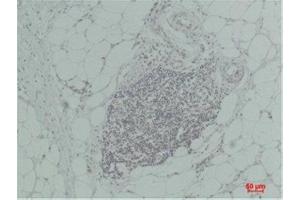 Immunohistochemistry (IHC) analysis of paraffin-embedded Human Breast Carcinoma using TNF a Rabbit Polyclonal Antibody diluted at 1:200.