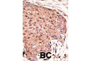 Formalin-fixed and paraffin-embedded human cancer tissue reacted with ZMIZ1 polyclonal antibody  , which was peroxidase-conjugated to the secondary antibody, followed by AEC staining. (ZMIZ1 Antikörper  (C-Term))