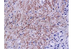 Formalin-fixed and paraffin embedded human prostate tissue labeled with Anti-Androgen receptor Polyclonal Antibody, Unconjugated (ABIN725240) at 1:200, followed by conjugation to the secondary antibody and DAB staining (Androgen Receptor Antikörper  (AA 825-919))