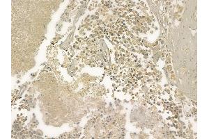 ABIN6261019 and ABIN6273216 at 1/100 staining human prostate carcinoma by IHC-P. (CRAT Antikörper  (N-Term))