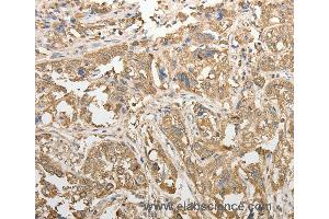 Immunohistochemistry of Human esophagus cancer using ADHFE1 Polyclonal Antibody at dilution of 1:50 (ADHFE1 Antikörper)