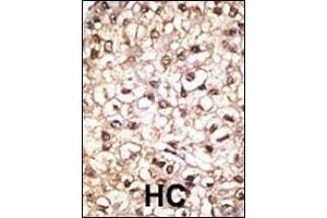 Formalin-fixed and paraffin-embedded human cancer tissue reacted with the primary antibody, which was peroxidase-conjugated to the secondary antibody, followed by AEC staining.