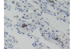 Detection of GR in Human Lung cancer Tissue using Polyclonal Antibody to Glucocorticoid Receptor (GR) (Glucocorticoid Receptor Antikörper  (AA 598-755))
