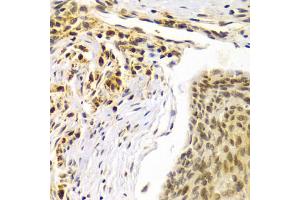 Immunohistochemistry of paraffin-embedded human esophageal cancer using SMARCE1 Antibody (ABIN5973097) at dilution of 1/100 (40x lens). (SMARCE1 Antikörper)