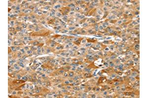 The image on the left is immunohistochemistry of paraffin-embedded Human liver cancer tissue using ABIN7129263(DSTYK Antibody) at dilution 1/25, on the right is treated with fusion protein. (DSTYK Antikörper)
