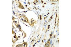 Immunohistochemistry of paraffin-embedded human liver cancer using TMOD4 antibody (ABIN5974100) at dilution of 1/100 (40x lens). (Tropomodulin 4 Antikörper)
