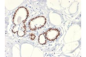 IHC testing of FFPE human breast cancer with Estrogen Receptor antibody (clone ESR1/2299R).